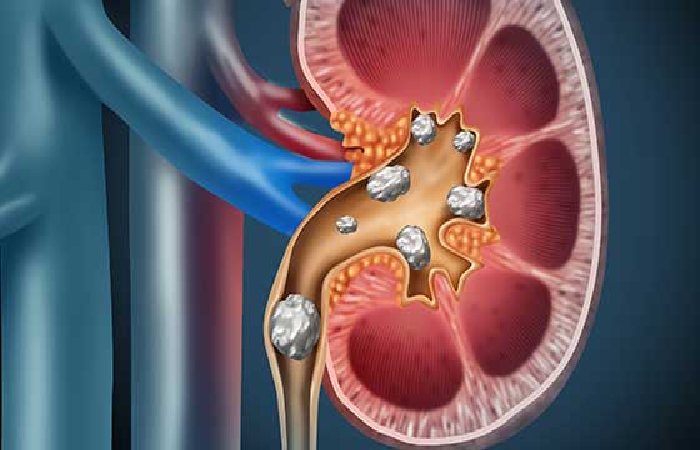 Overview Kidney stone