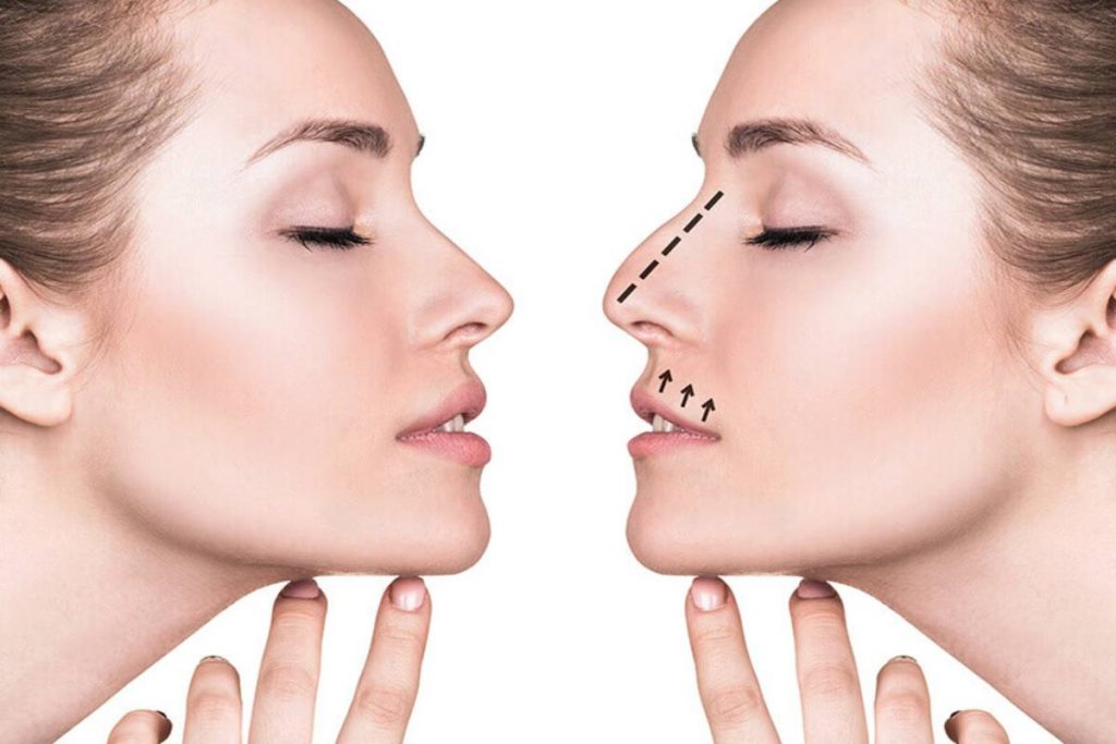 Rhinoplasty Surgery_ Overview, Benefits, Types, And More