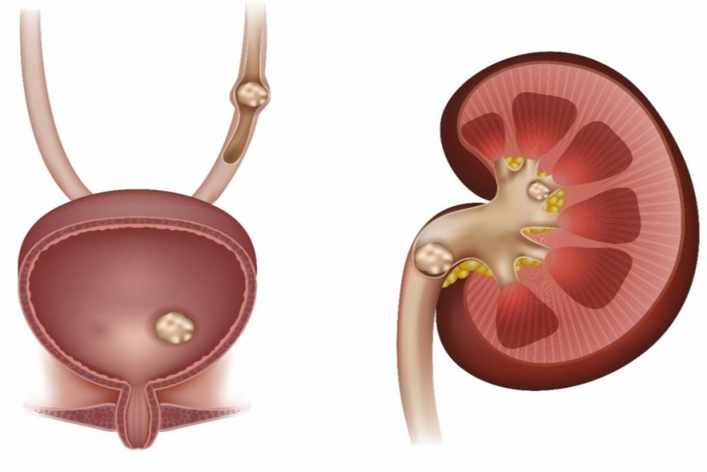 What are Kidney stones? – Overview, Types, Factors, And More