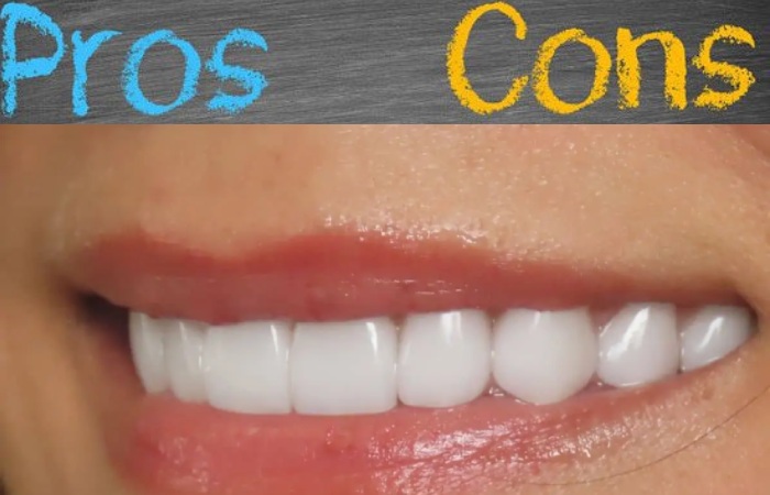 Pros of Composite Veneers