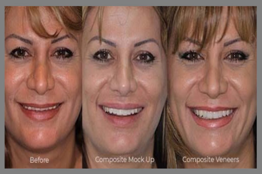 composite bonding for teeth