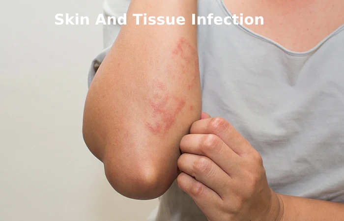 Skin And Tissue Infection
