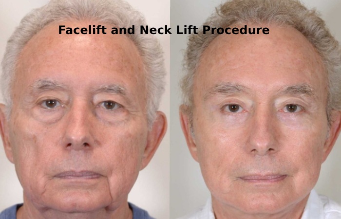 Facelift and Neck Lift Procedure
