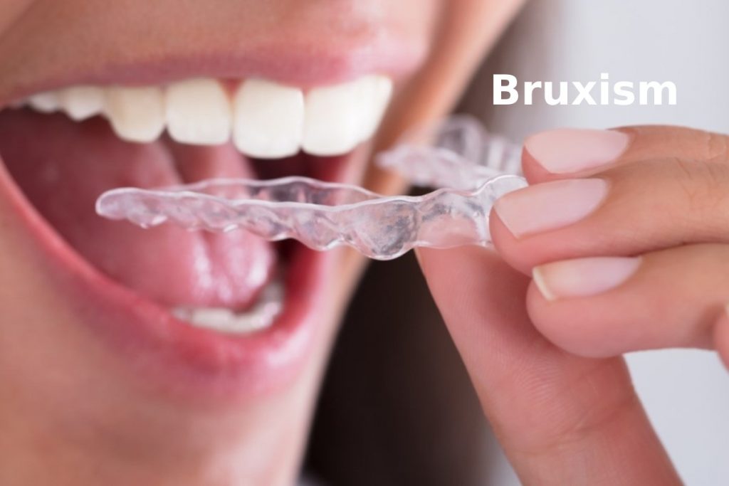 What is Bruxism? And How a Mouth Guard Can Help