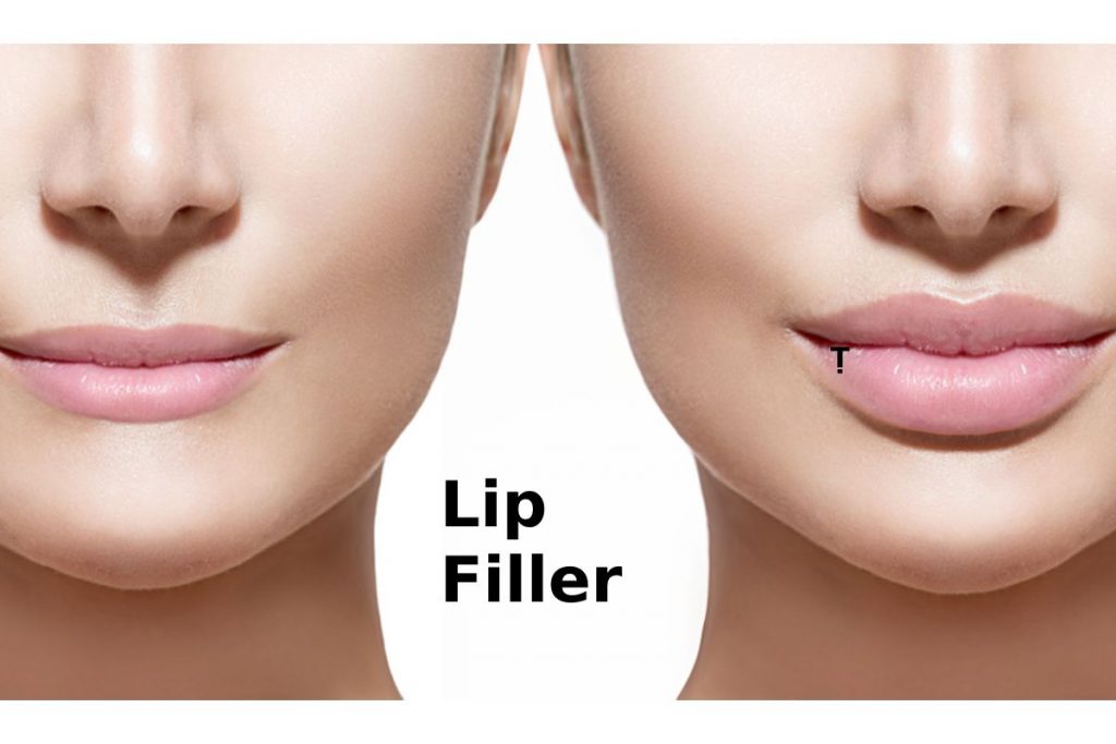 How Long Do Lip Filler Results Last?