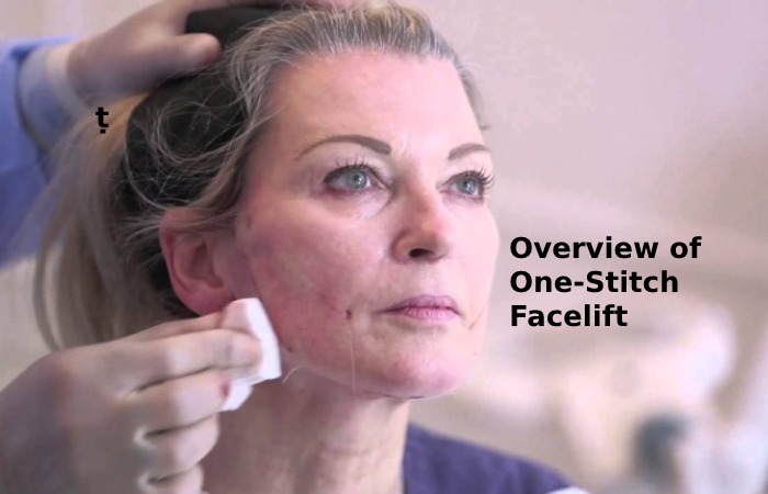 Overview of One-Stitch Facelift