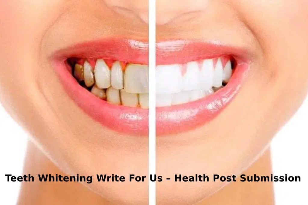 Teeth Whitening Write For Us – Health Post Submission