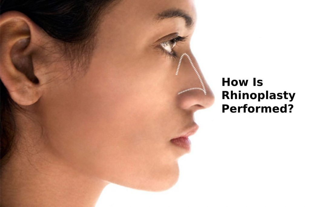 How Is Rhinoplasty Performed?