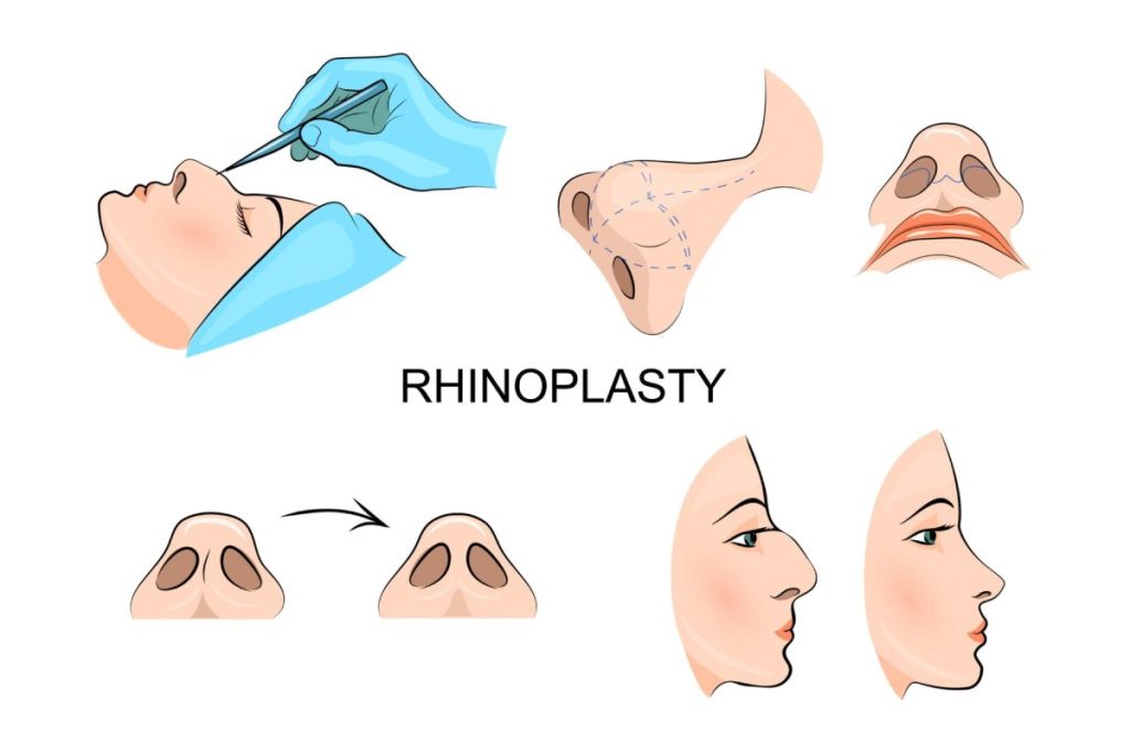 All About Cosmetic Nose Surgery
