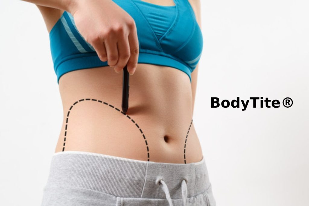 What You Need To Know About BodyTite®