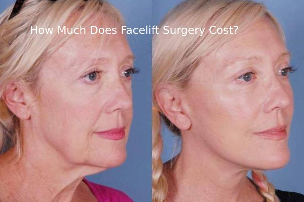 How Much Does Facelift Surgery Cost? 