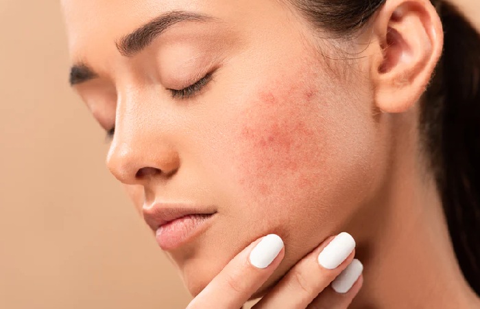 What is Acne Scars?
